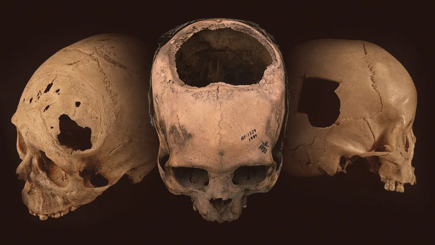 Peruust on leitud rohkem trepaneeritud kolpi kui mujalt maailmas kokku. Muistsed inkad suutsid seda ohtliku protseduuri läbi viia enneolematu osavusega.