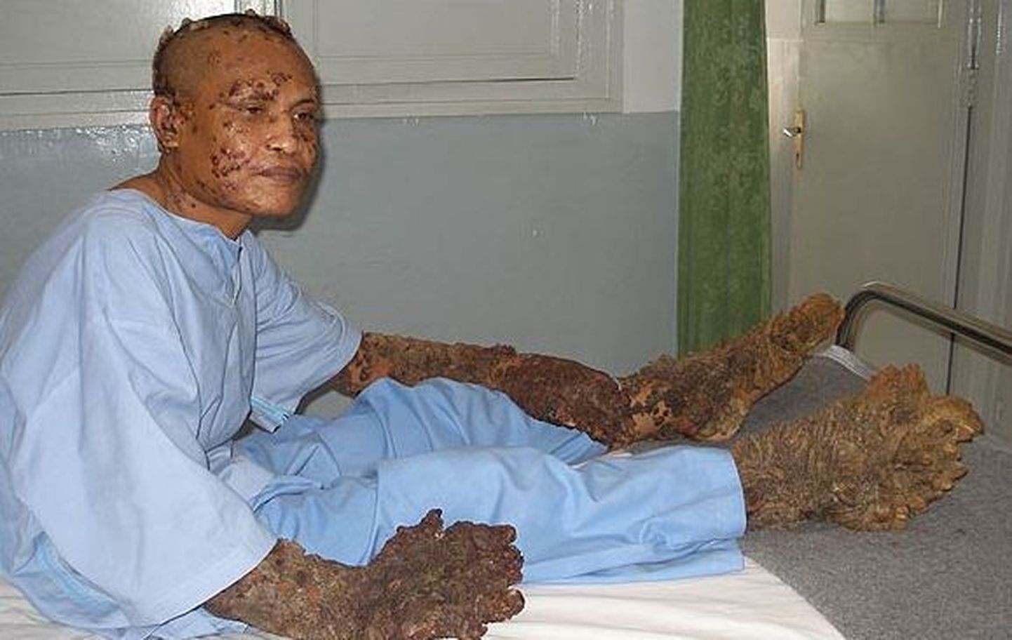 «Juurtega mees» Dede Koswara enne operatsioone