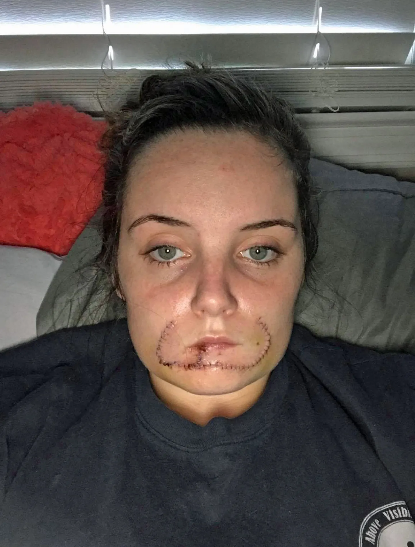 Kayla Hayes langes 17-aastasena julma rünnaku ohvriks, kui tema endine poiss-sõber tal alahuule ära hammustas