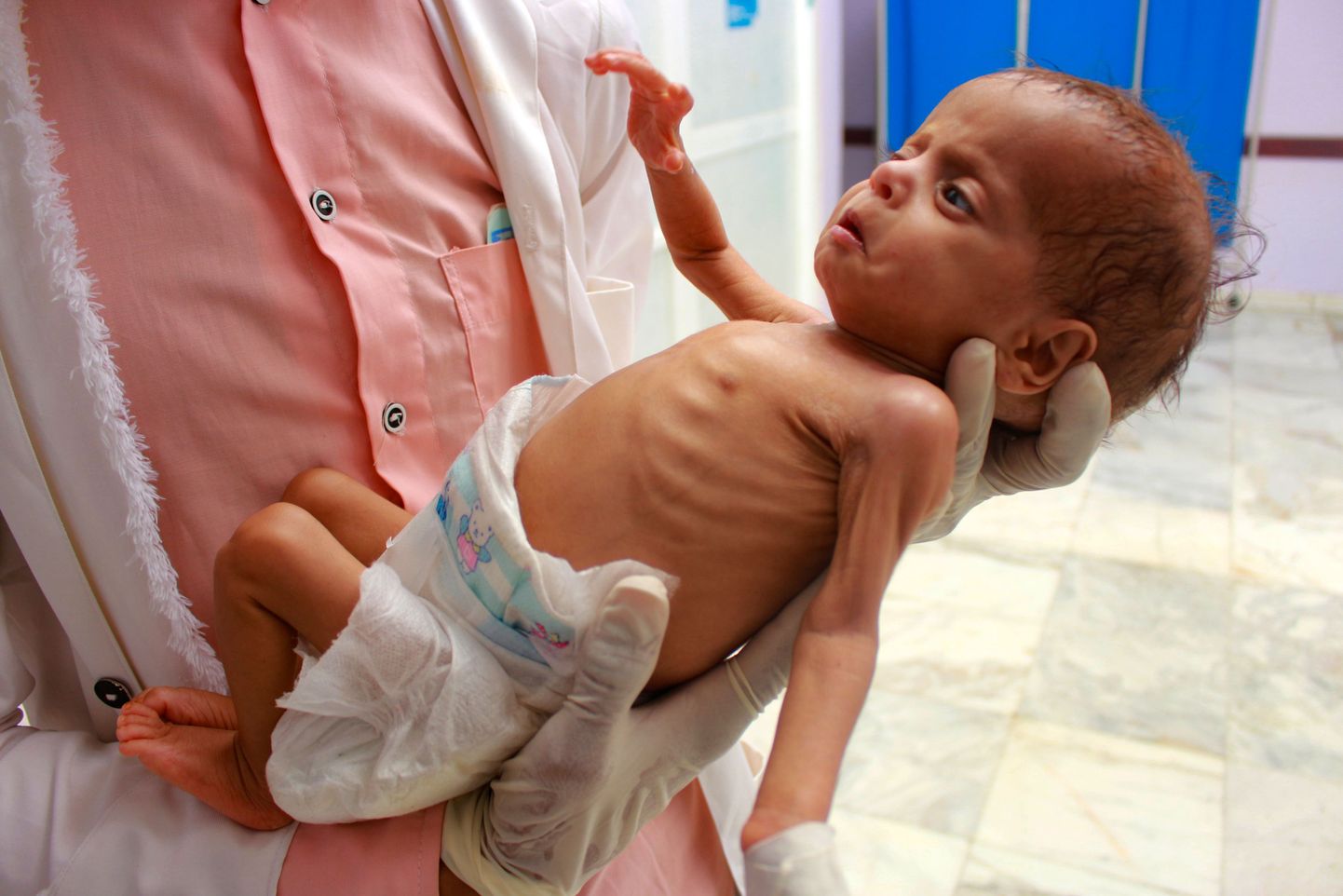 Ravikeskuse töötaja hoiab alatoitumuse all kannatavat Jeemeni last põhjas Hajjahi provintsis 5. juulil, 2020. aastal. ÜRO nimetab Jeemeni sõda maailma halveimaks humanitaarkriisiks. Miljonid Jeemeni lapsed nälgivad, kuna riik ei saa abi.