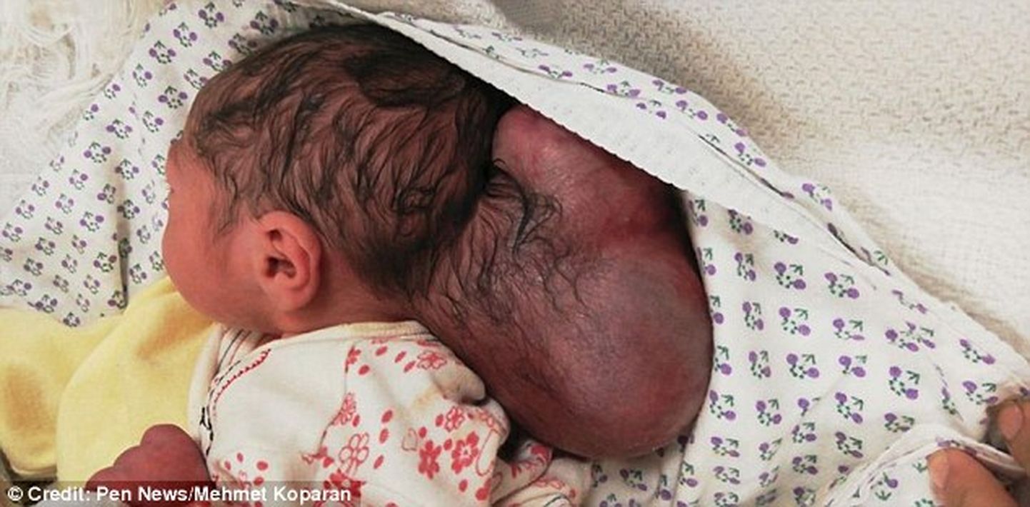 Raskekujuline ajusong jätab mulje, nagu beebil oleks kaks pead.
