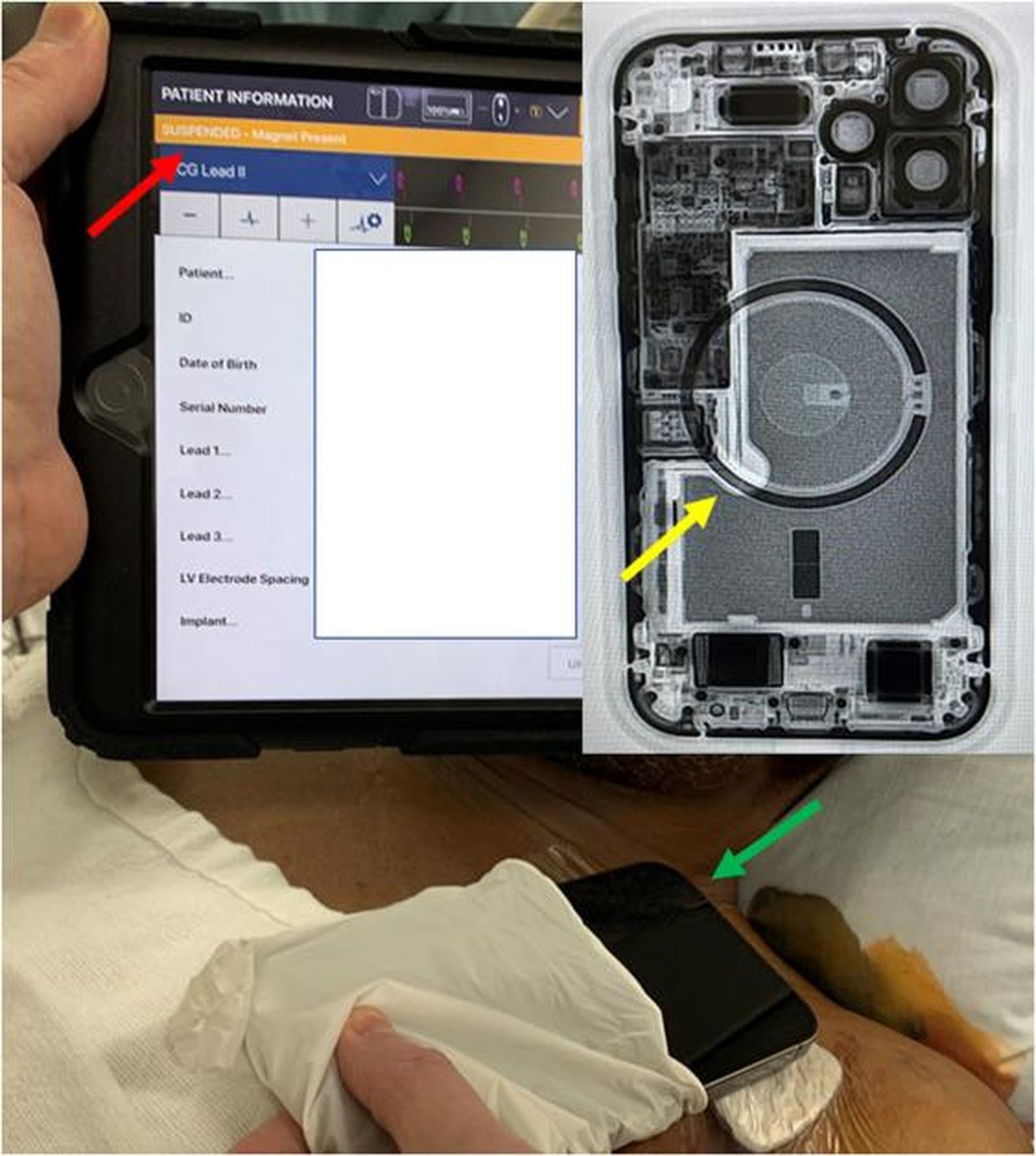 Implanteeritud defibrillaatrori programmeerimisliidesel on näha oranž riba (punase noolega näidatud) mis osutab sellele, et defibrilaator pole töökorras. See juhtus, kui patsiendi rinnale asetati sisse ehitatud juhtmevaba laadismisfunktsiooniga nutitelefon.