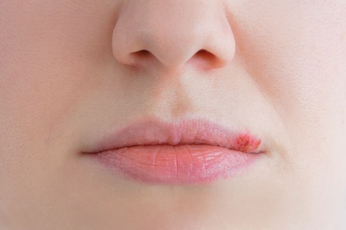 Вся правда о простуде на губах: причины и лечение
