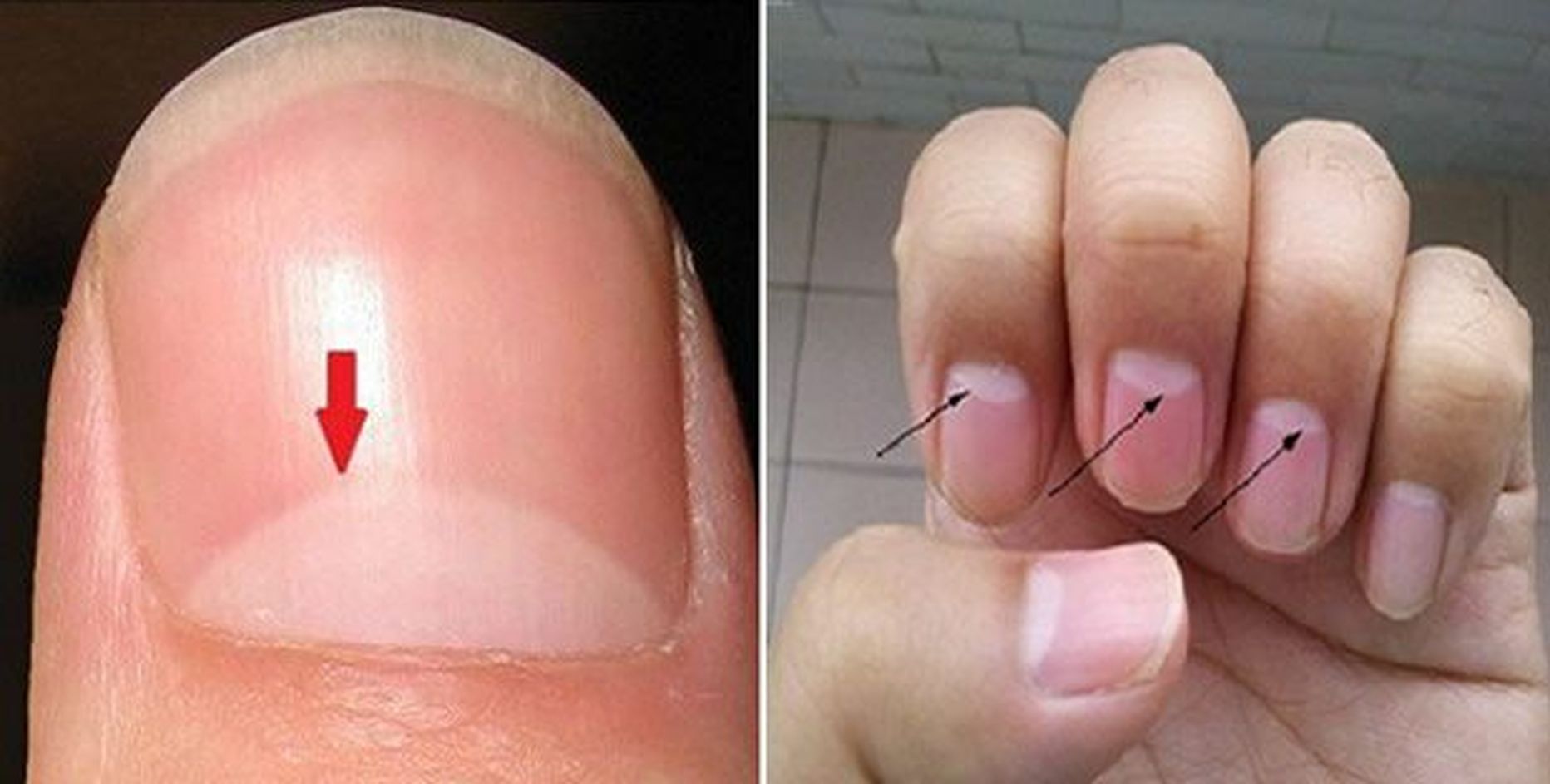 Что означают полосы на ногтях. Поперечные полосы на ногтях. Белое пятно у основания ногтя. Горизонтальные полоски на ногтях. Белые полоски под ногтями.