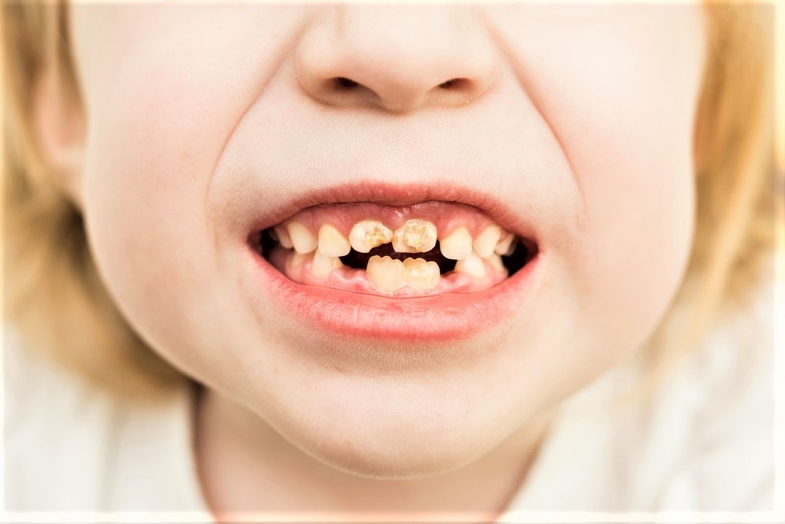 Katkised hambad kahjustavad tervist. Pilt on illustratiivne.