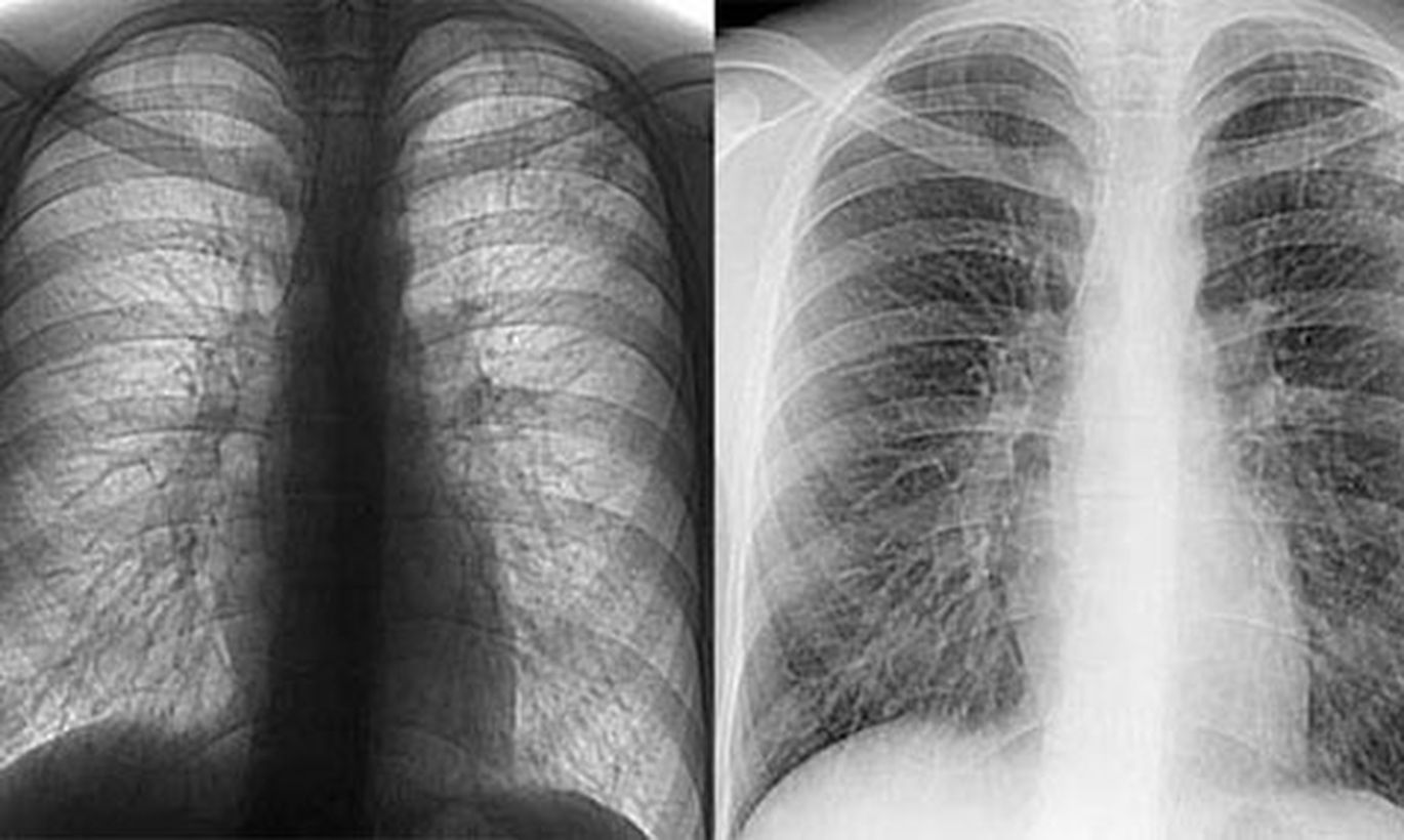 Туберкулёз на флюорографии
